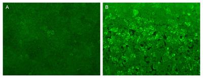 Case report: The case report of ofatumumab, a fully human anti-CD20 monoclonal antibody, in the treatment of KLHL11 encephalitis